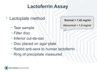 Lactoferrin Assay
• Lactoplate method
− Tear sample
− Filter disc
− Inferior cul-de-sac
− Disc placed on agar plate
− Rabbit anti-sera to human lactoferrin
− Ring of precipitate measured
Normal = 1.42 mg/ml
Abnormal < 1.0 mg/ml
 