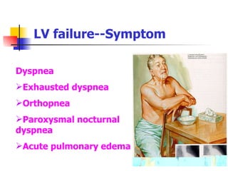 LV failure--Symptom Dyspnea Exhausted dyspnea Orthopnea  Paroxysmal nocturnal  dyspnea Acute pulmonary edema 