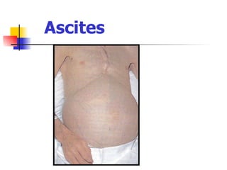 Ascites 