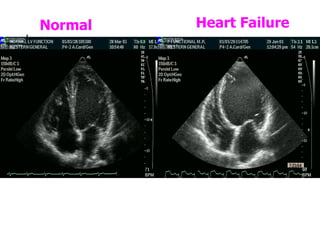 Normal Heart Failure 
