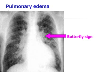 Pulmonary edema Butterfly sign   