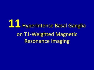 11Hyperintense Basal Ganglia
on T1-Weighted Magnetic
Resonance Imaging
 