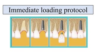 Immediate loading protocol
 