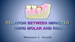 Mohammed	A.	Alawadh
RELATION BETWEEN IMPACTED
THIRD MOLAR AND PAIN 
 