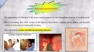The appearance of infection is the most common reason for the immediate removal of wisdom teeth.
Due to crowding that often occurs in the area of third molar eruption, food, debris, and bacteria
collect in areas that are impossible to clean.
This can lead to serious and life-threatening infection.
Infection (pericornitis)
 