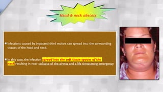 Infections caused by impacted third molars can spread into the surrounding
tissues of the head and neck.
In this case, the infection spread into the soft tissue spaces of the
neck resulting in near collapse of the airway and a life threatening emergency.
Head & neck abscess
 