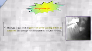 This type of cyst tends to grow very slowly causing little to no
symptoms until damage, such as severe bone loss, has occurred.
Dentigerous cyst
 