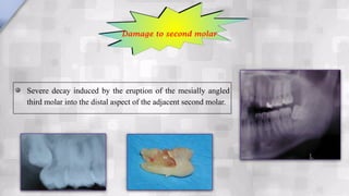 Severe decay induced by the eruption of the mesially angled
third molar into the distal aspect of the adjacent second molar.
Damage to second molar
 