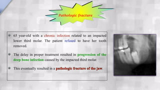 65 year-old with a chronic infection related to an impacted
lower third molar. The patient refused to have her tooth
removed.
The delay in proper treatment resulted in progression of the
deep bone infection caused by the impacted third molar.
This eventually resulted in a pathologic fracture of the jaw.
Pathologic fracture
 