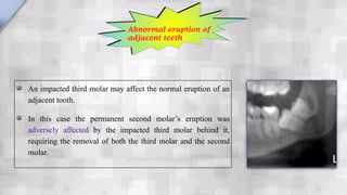 An impacted third molar may affect the normal eruption of an
adjacent tooth.
In this case the permanent second molar’s eruption was
adversely affected by the impacted third molar behind it,
requiring the removal of both the third molar and the second
molar.
Abnormal eruption of
adjacent teeth
 