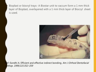 Biocryl Inj indirect bonding | PPTX