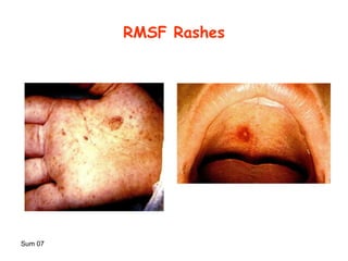 Rash Of Rmsf 11 infectious disease Chlamydia ,Rickettsiae,Ehrlichia | PPT