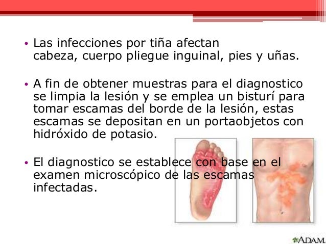 La psoriasis el alcohol los antibióticos