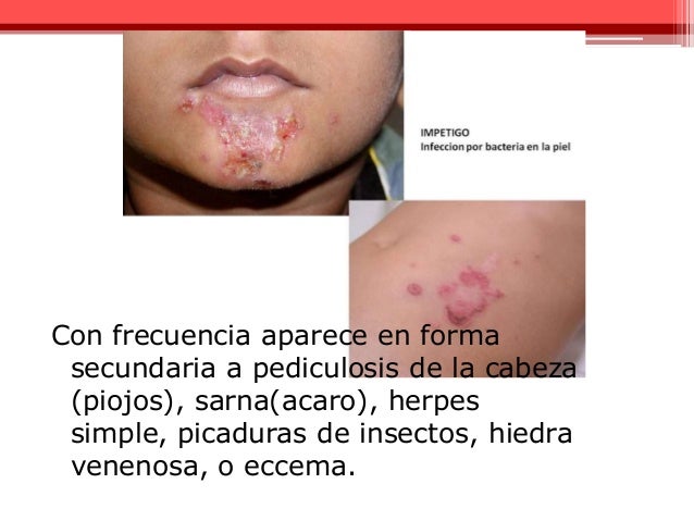 Del origen de hongos de la eccema