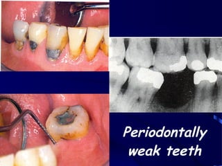 Week Teeth's introduction to removable partial denture | PPT