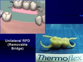 Transional Rpd introduction to removable partial denture | PPT