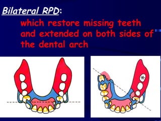 The Dual Path Rpd introduction to removable partial denture | PPT