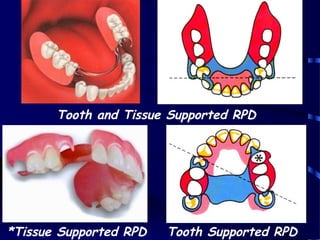 introduction to removable partial denture | PPT