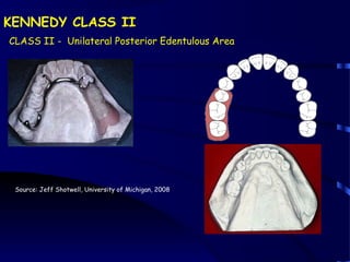 introduction to removable partial denture | PPT