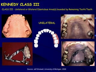 introduction to removable partial denture | PPT