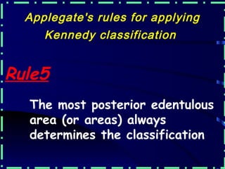 Appleton Rule introduction to removable partial denture | PPT