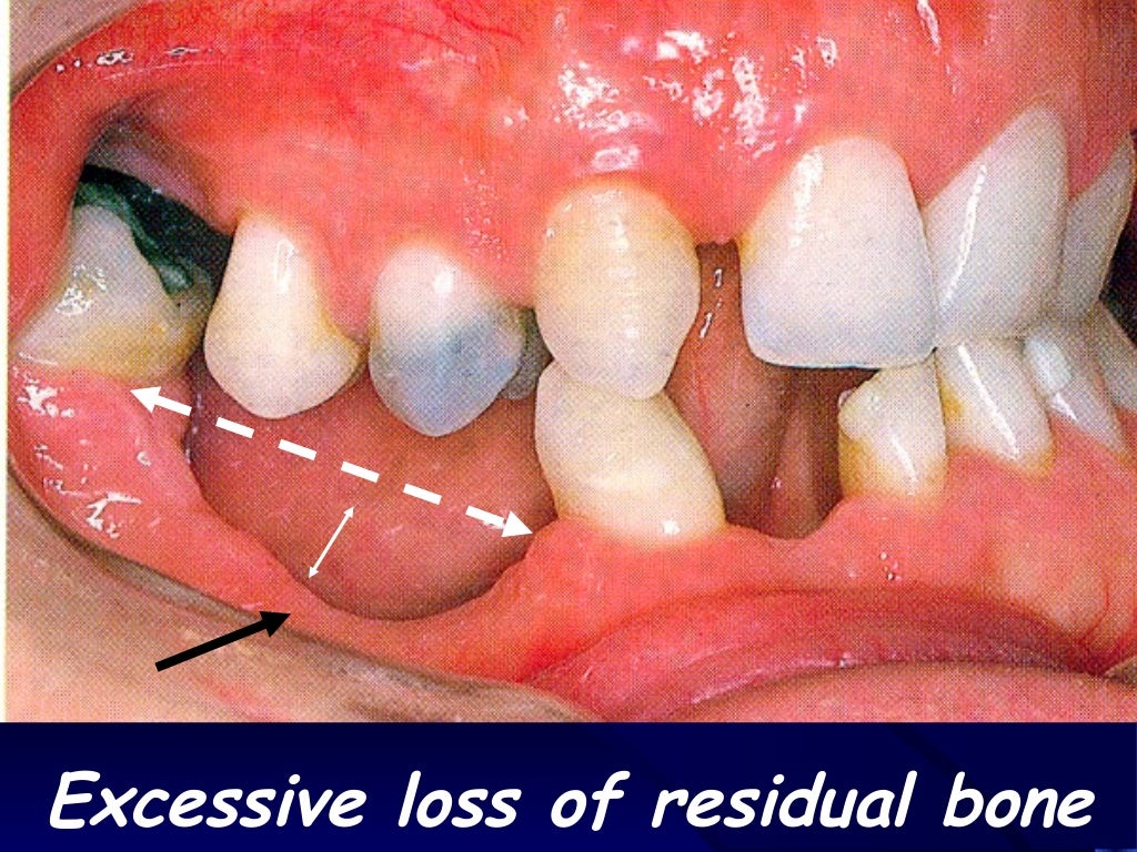 introduction to removable partial denture