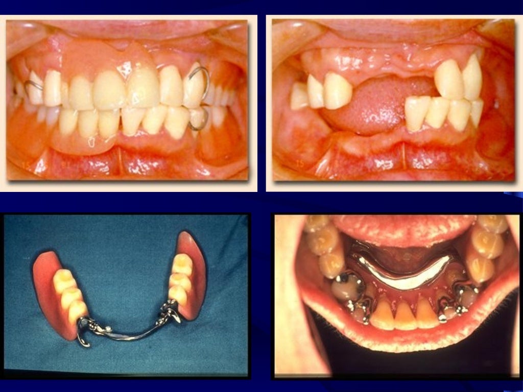 introduction to removable partial denture