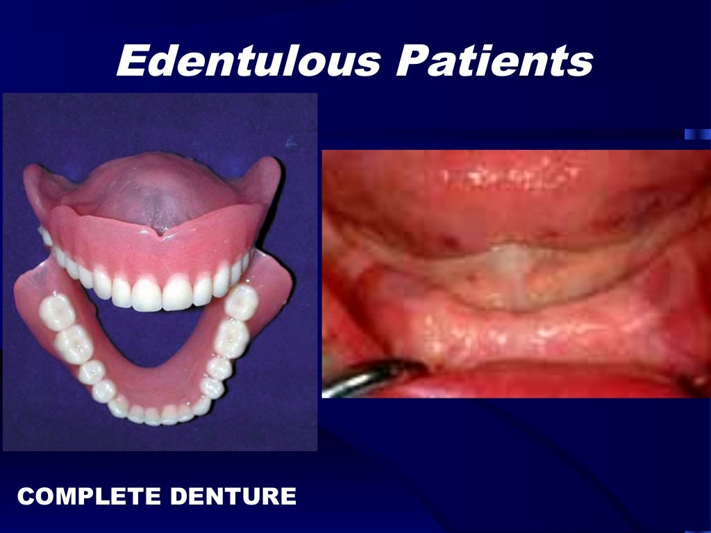 introduction to removable partial denture