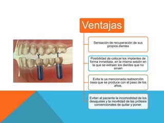 Ventajas
   Sensación de recuperación de sus
           propios dientes


  Posibilidad de colocar los implantes de
 forma inmediata, en la misma sesión en
   la que se extraen los dientes que no
                  sirven


   Evita la ya mencionada reabsorción
 ósea que se produce con el paso de los
                  años.


 Evitan al paciente la incomodidad de los
 desajustes y la movilidad de las prótesis
    convencionales de quitar y poner.
 