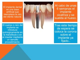 El implante dental
                       Al cabo de unas
   es una base          6 semanas el
    artificial que         implante
reemplaza la raíz       cicatriza y se
del diente natural.
                       suelda al hueso.

El cuerpo o raíz del   Tras este tiempo
    implante se          de espera se
      introduce
quirúrgicamente en     coloca la corona
 la mandíbula o en          sobre el
el maxilar mediante       implante ya
     un sencillo
   procedimiento.            fijado..
 