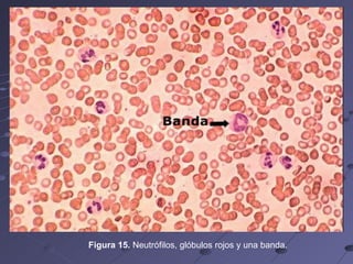 Figura 15.  Neutrófilos, glóbulos rojos y una banda. 