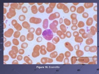 Figura 18.  Eosinófilo  