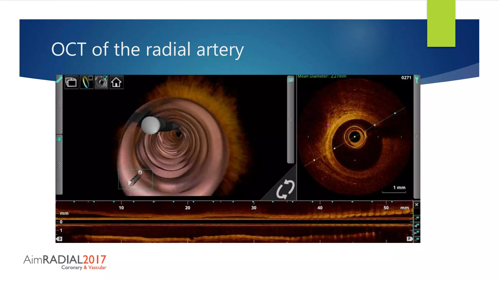 OCT of the radial artery
 