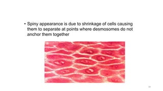 • Spiny appearance is due to shrinkage of cells causing
them to separate at points where desmosomes do not
anchor them together
39
 