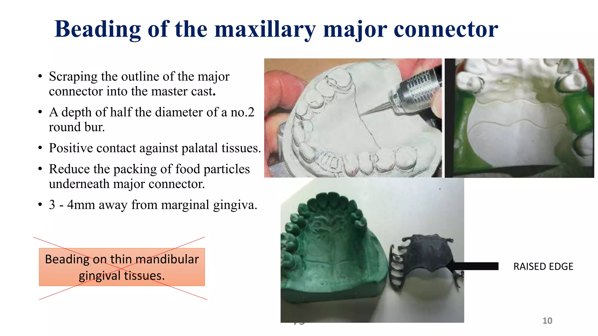 Beading of the maxillary major connector
• Scraping the outline of the major
connector into the master cast.
• A depth of half the diameter of a no.2
round bur.
• Positive contact against palatal tissues.
• Reduce the packing of food particles
underneath major connector.
• 3 - 4mm away from marginal gingiva.
1075
RAISED EDGE
Beading on thin mandibular
gingival tissues.
 