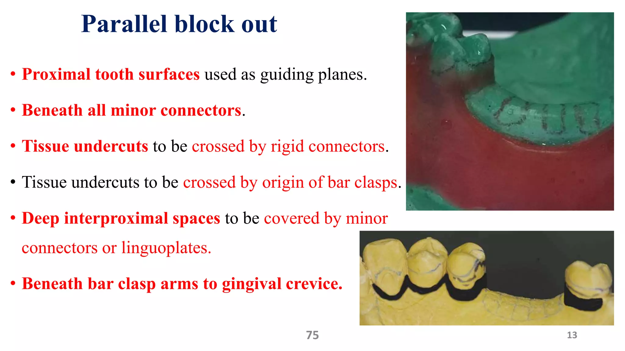 Parallel block out
• Proximal tooth surfaces used as guiding planes.
• Beneath all minor connectors.
• Tissue undercuts to be crossed by rigid connectors.
• Tissue undercuts to be crossed by origin of bar clasps.
• Deep interproximal spaces to be covered by minor
connectors or linguoplates.
• Beneath bar clasp arms to gingival crevice.
1375
 