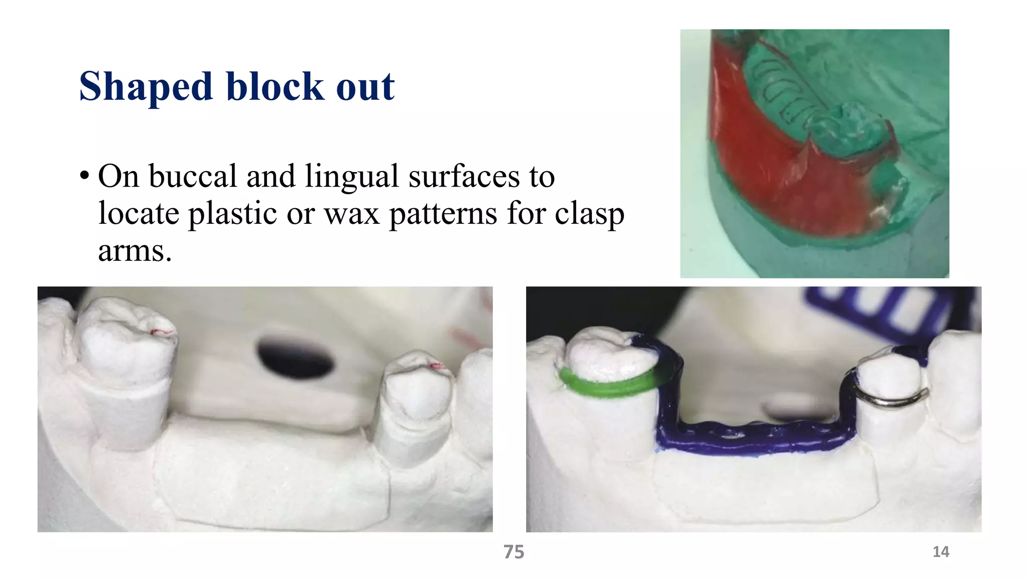 Shaped block out
• On buccal and lingual surfaces to
locate plastic or wax patterns for clasp
arms.
1475
 