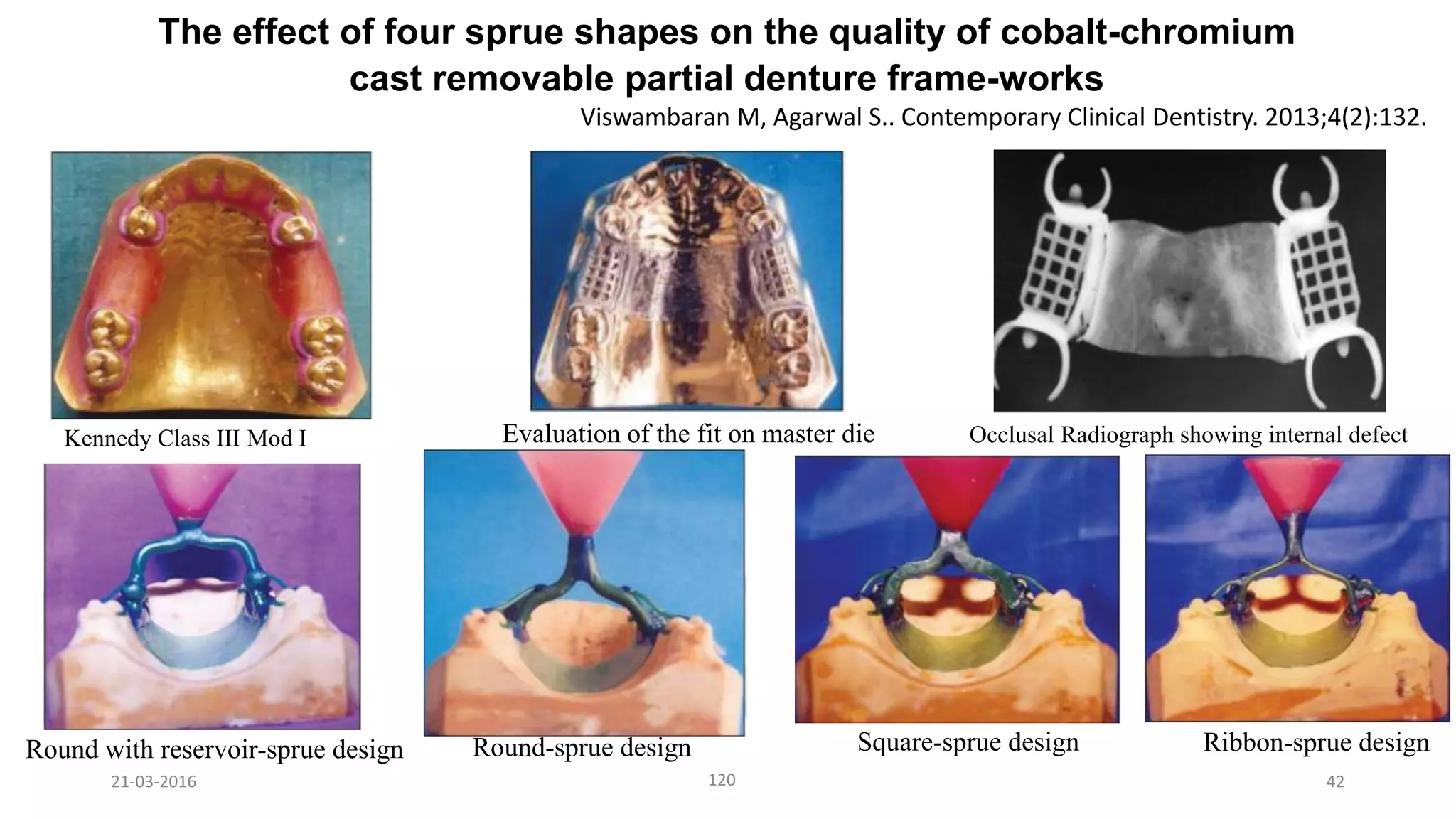 42
The effect of four sprue shapes on the quality of cobalt-chromium
cast removable partial denture frame-works
Kennedy Class III Mod I
Round with reservoir-sprue design Square-sprue designRound-sprue design Ribbon-sprue design
Evaluation of the fit on master die
Viswambaran M, Agarwal S.. Contemporary Clinical Dentistry. 2013;4(2):132.
21-03-2016 120
Occlusal Radiograph showing internal defect
 