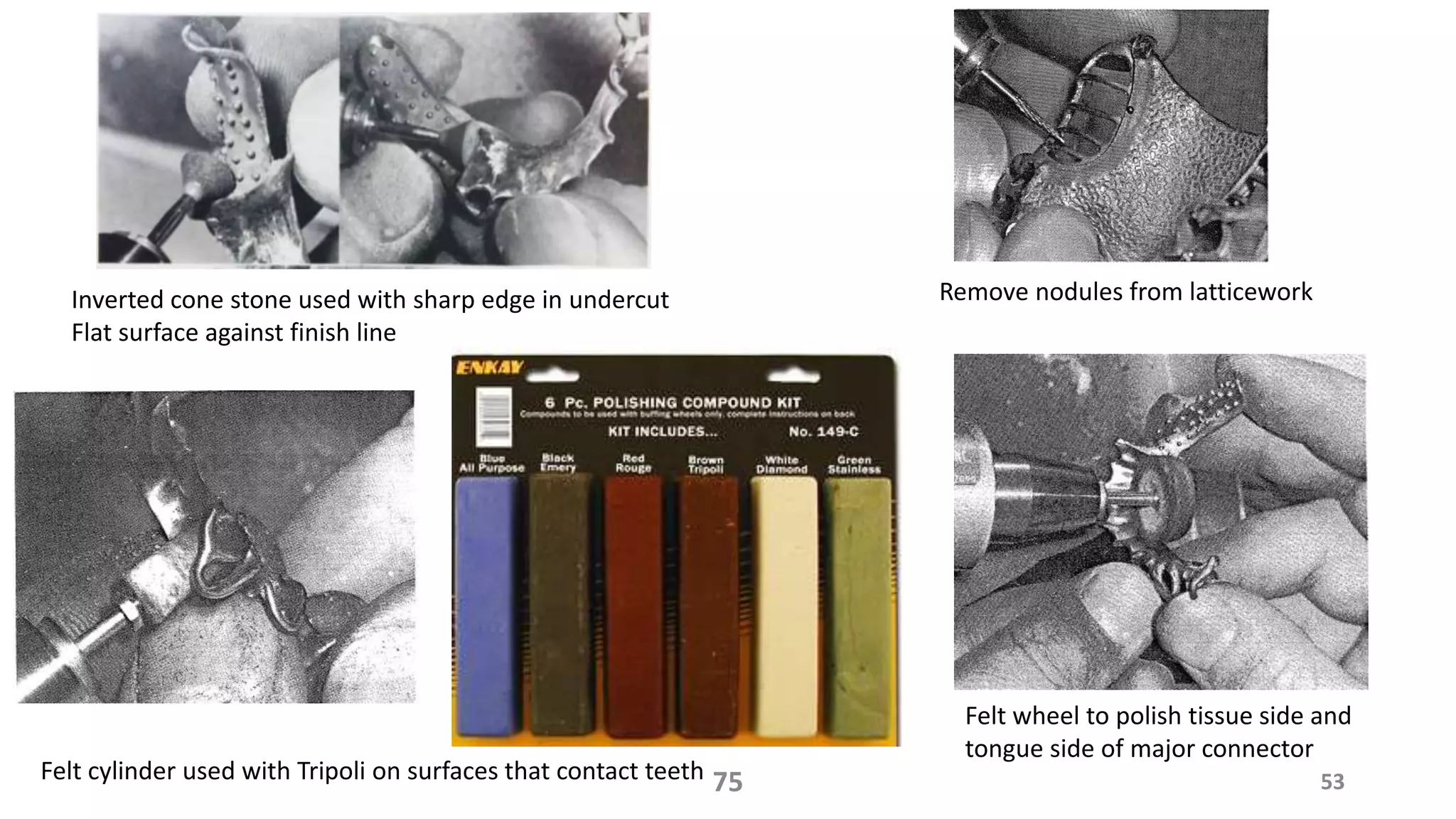 Inverted cone stone used with sharp edge in undercut
Flat surface against finish line
Remove nodules from latticework
5375Felt cylinder used with Tripoli on surfaces that contact teeth
Felt wheel to polish tissue side and
tongue side of major connector
 