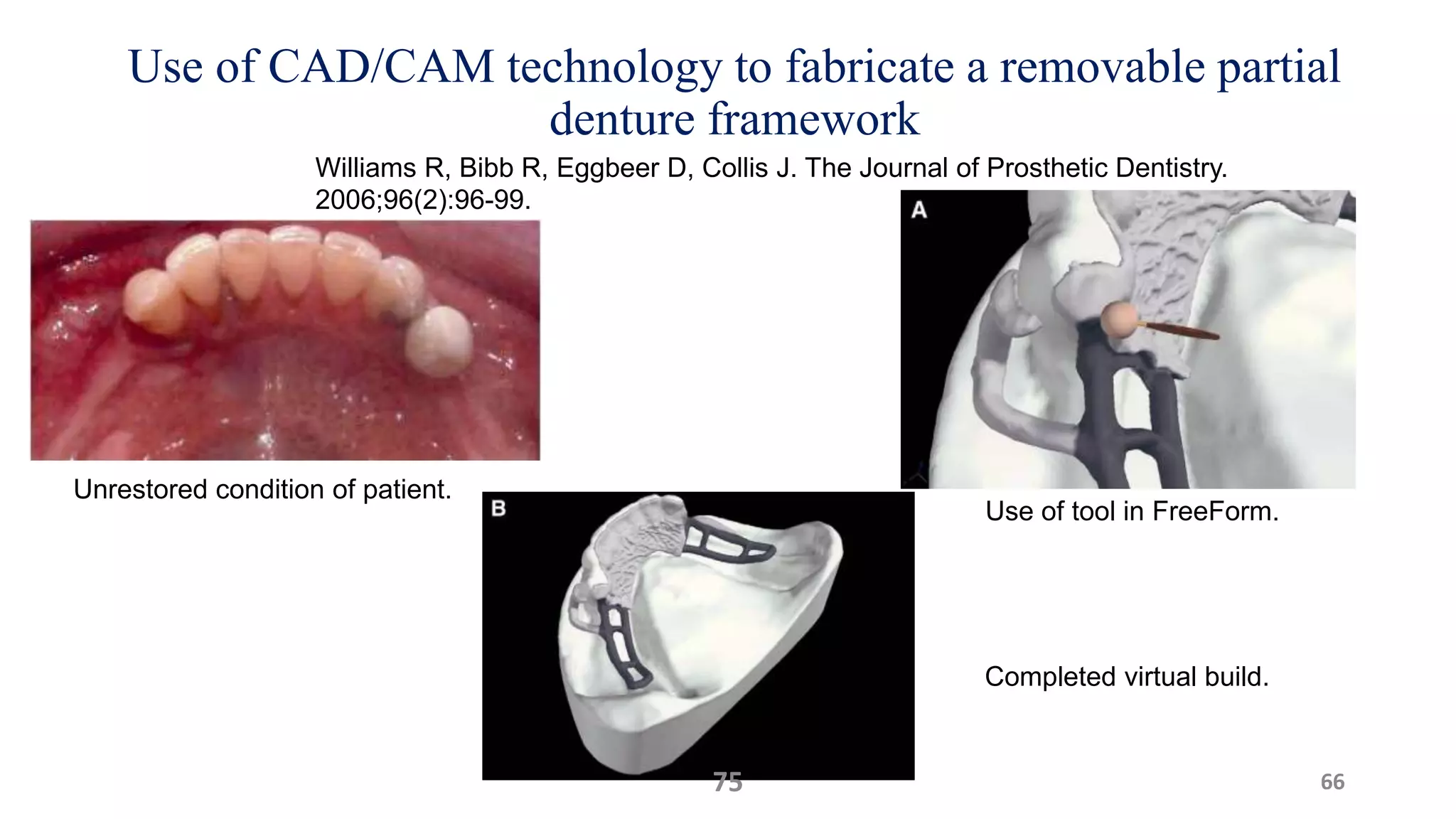 Use of CAD/CAM technology to fabricate a removable partial
denture framework
66
Unrestored condition of patient.
Use of tool in FreeForm.
Completed virtual build.
75
Williams R, Bibb R, Eggbeer D, Collis J. The Journal of Prosthetic Dentistry.
2006;96(2):96-99.
 