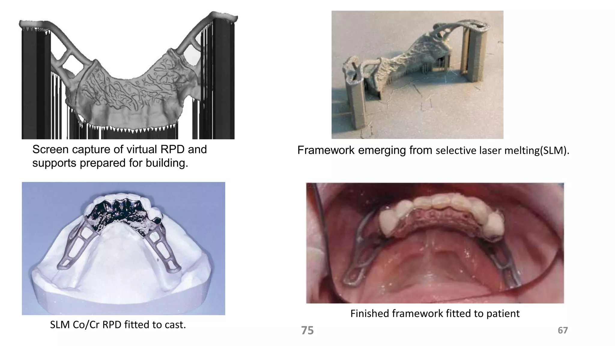 67
Screen capture of virtual RPD and
supports prepared for building.
Framework emerging from selective laser melting(SLM).
75SLM Co/Cr RPD fitted to cast.
Finished framework fitted to patient
 