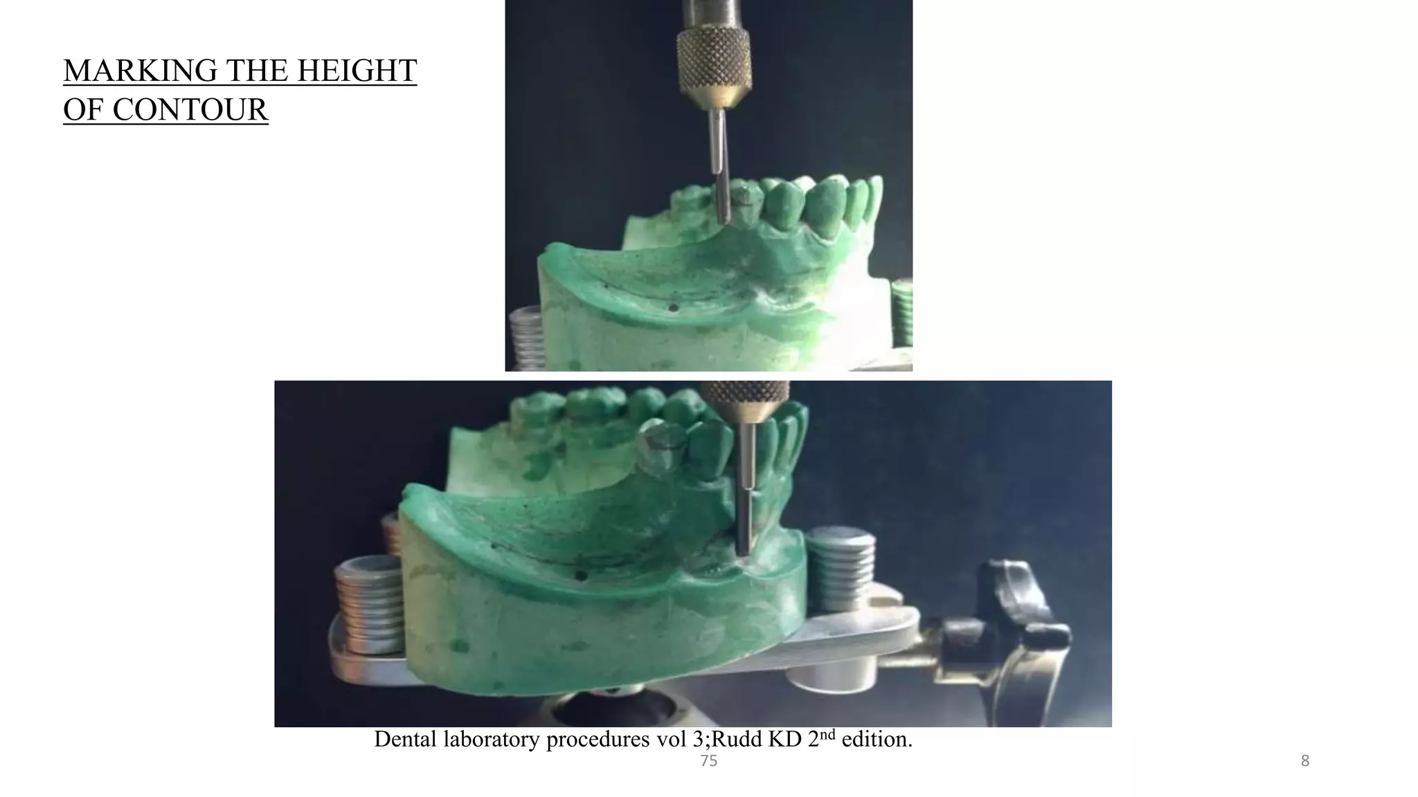 75 8
Dental laboratory procedures vol 3;Rudd KD 2nd edition.
MARKING THE HEIGHT
OF CONTOUR
 