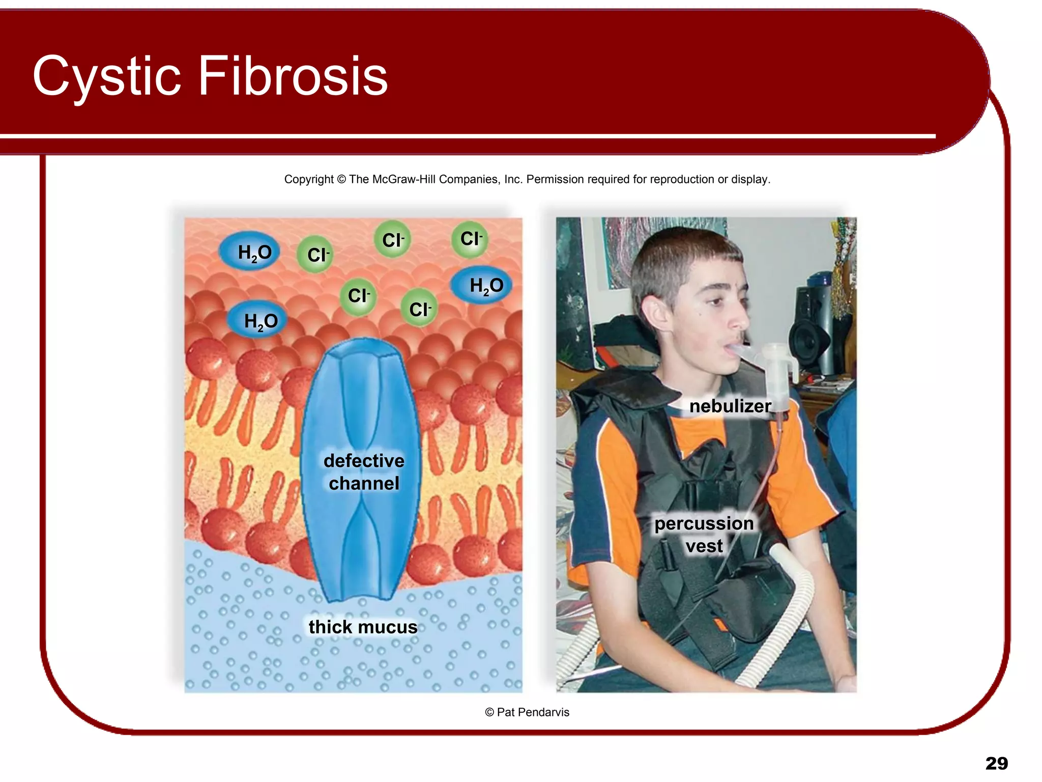 Cystic Fibrosis  Copyright © The McGraw-Hill Companies, Inc. Permission required for reproduction or display. Cl - H 2 O H 2 O H 2 O Cl - Cl - Cl - Cl - thick mucus defective channel nebulizer percussion vest © Pat Pendarvis 