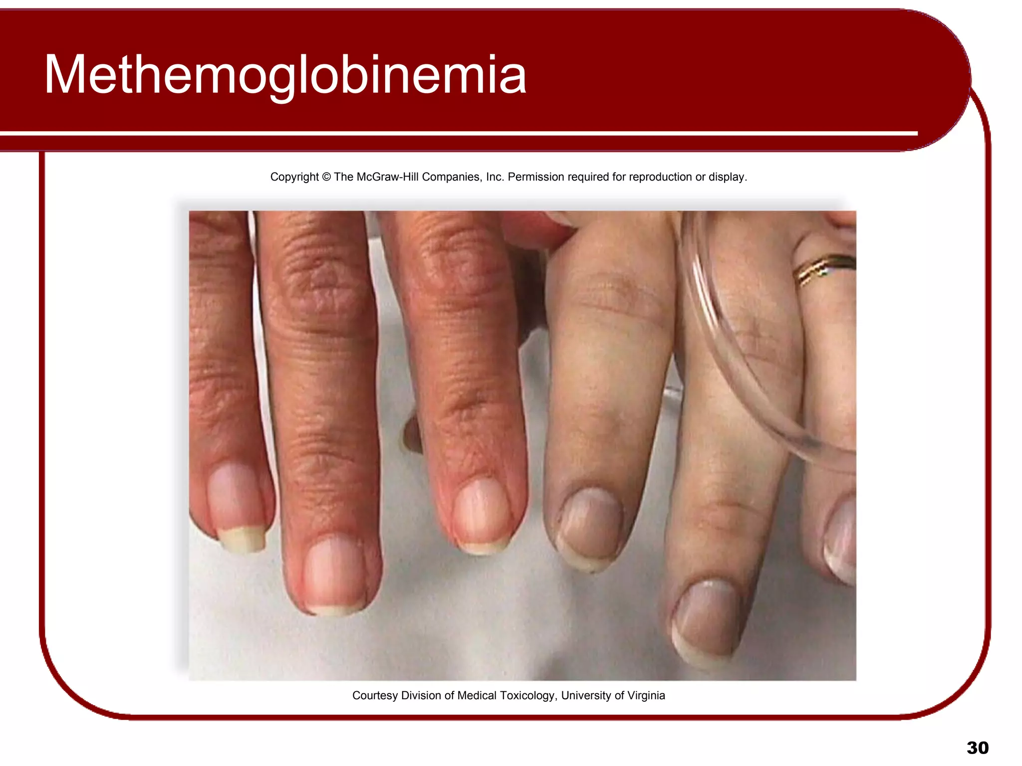 Methemoglobinemia Copyright © The McGraw-Hill Companies, Inc. Permission required for reproduction or display. Courtesy Division of Medical Toxicology, University of Virginia 