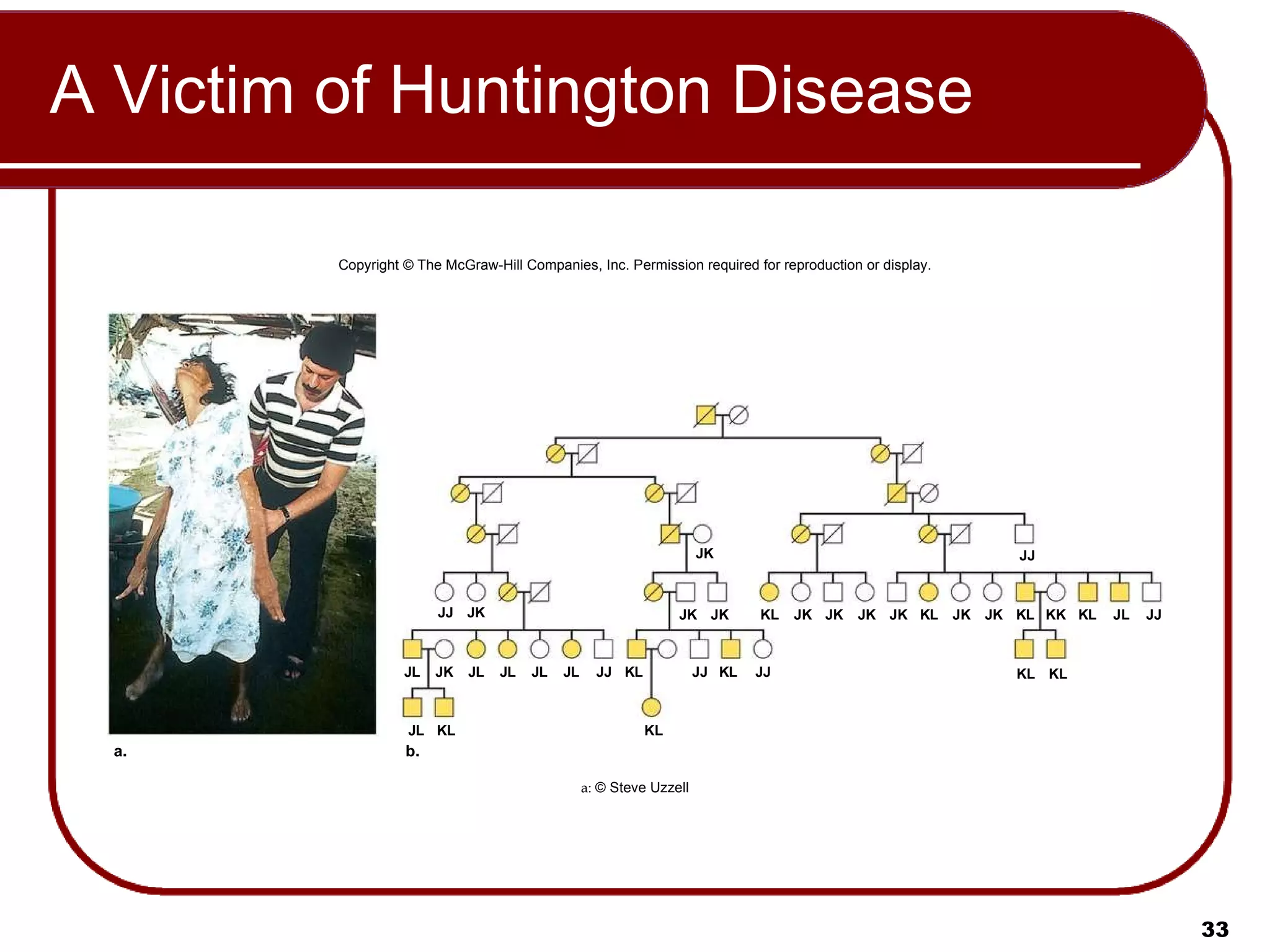 A Victim of Huntington Disease Copyright © The McGraw-Hill Companies, Inc. Permission required for reproduction or display. a:  © Steve Uzzell JJ JK JK JK JK JJ K L JK JK JK JK K L JK JK K L KK K L J L JJ J L JK J L K L KL J L J L J L J L JJ K L JJ K L JJ K L K L a. b. 