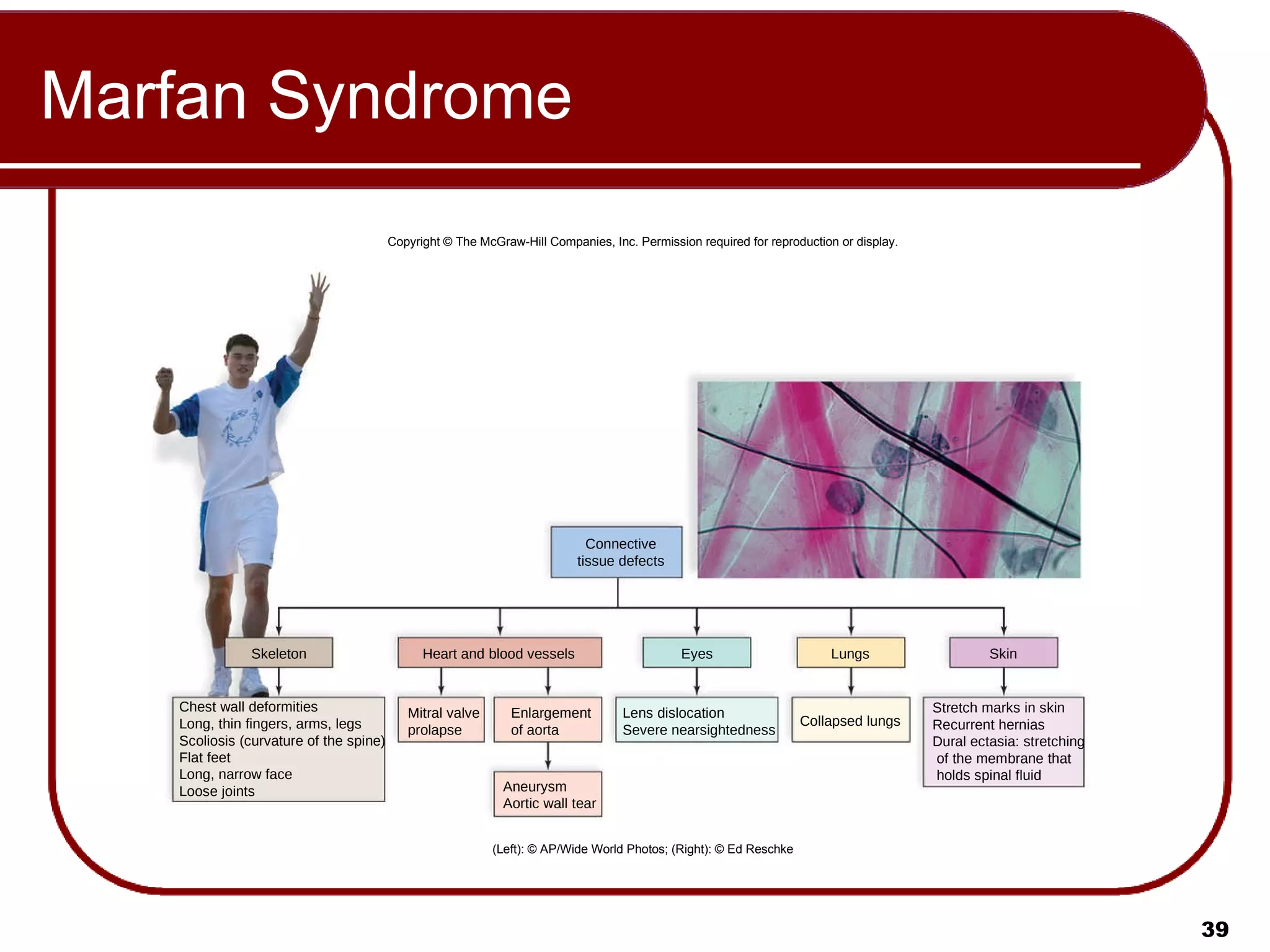 Marfan Syndrome Copyright © The McGraw-Hill Companies, Inc. Permission required for reproduction or display. (Left): © AP/Wide World Photos; (Right): © Ed Reschke Chest wall deformities Long, thin fingers, arms, legs Scoliosis (curvature of the spine) Flat feet Long, narrow face Loose joints Skeleton Skin Lungs Eyes Mitral valve prolapse Lens dislocation Severe nearsightedness Collapsed lungs Stretch marks in skin Recurrent hernias Dural ectasia: stretching of the membrane that holds spinal fluid Enlargement of aorta Heart and blood vessels Aneurysm Aortic wall tear Connective tissue defects 