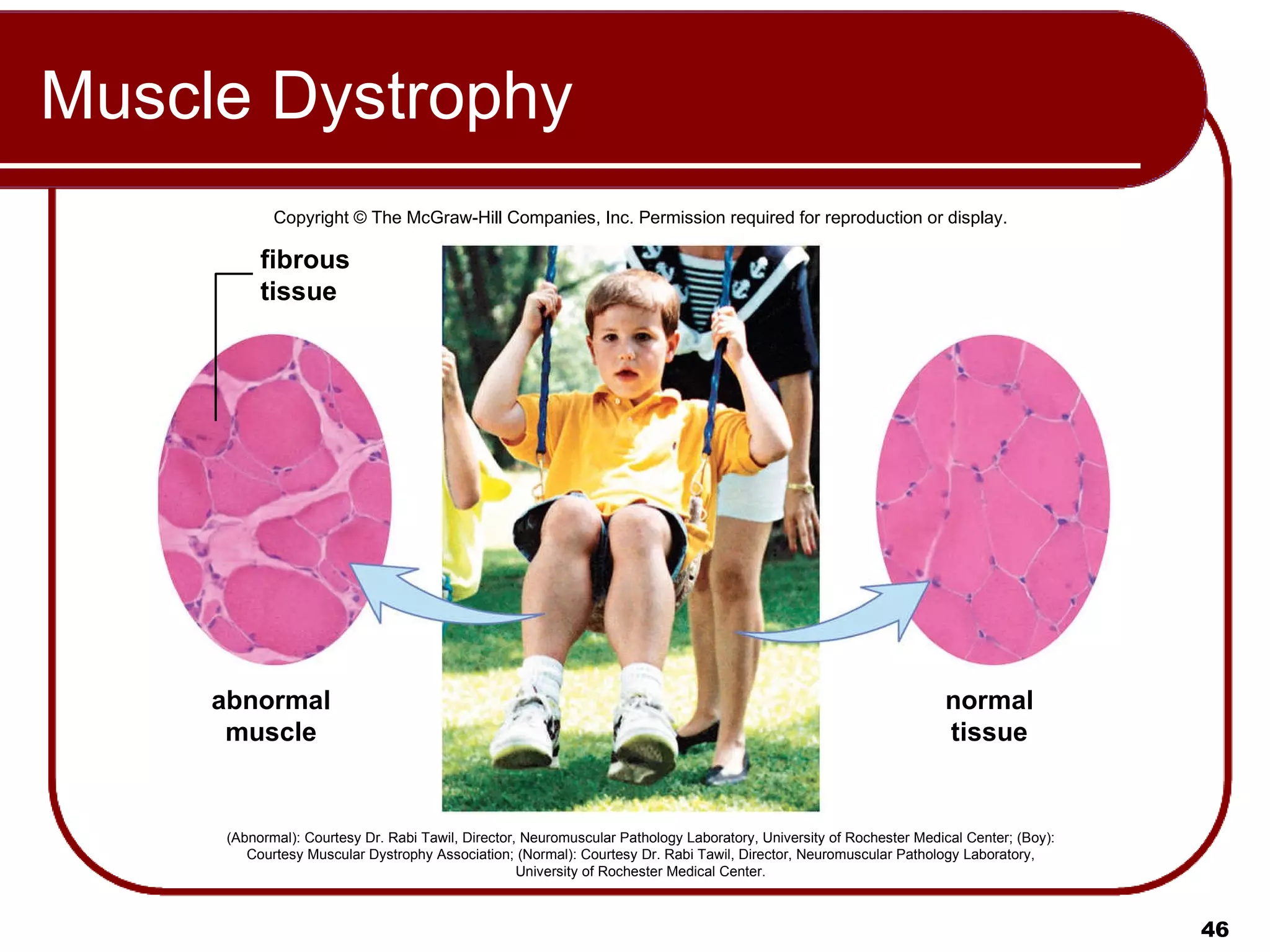 Muscle Dystrophy Copyright © The McGraw-Hill Companies, Inc. Permission required for reproduction or display. (Abnormal): Courtesy Dr. Rabi Tawil, Director, Neuromuscular Pathology Laboratory, University of Rochester Medical Center; (Boy): Courtesy Muscular Dystrophy Association; (Normal): Courtesy Dr. Rabi Tawil, Director, Neuromuscular Pathology Laboratory, University of Rochester Medical Center. abnormal muscle normal tissue fibrous tissue 