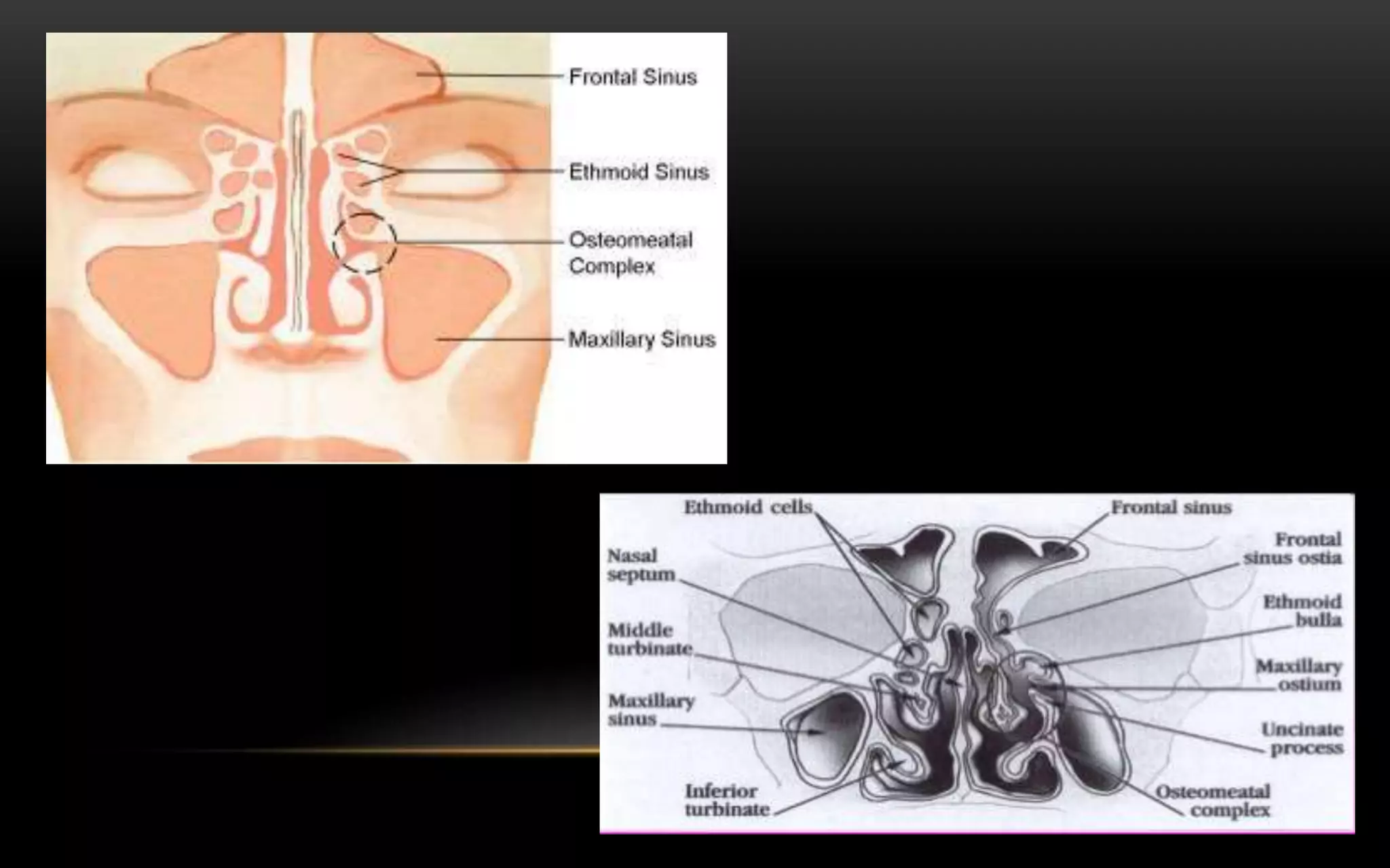 Haziness In Bilateral Sinus : Have Done An Xray Pns, Which States That ...
