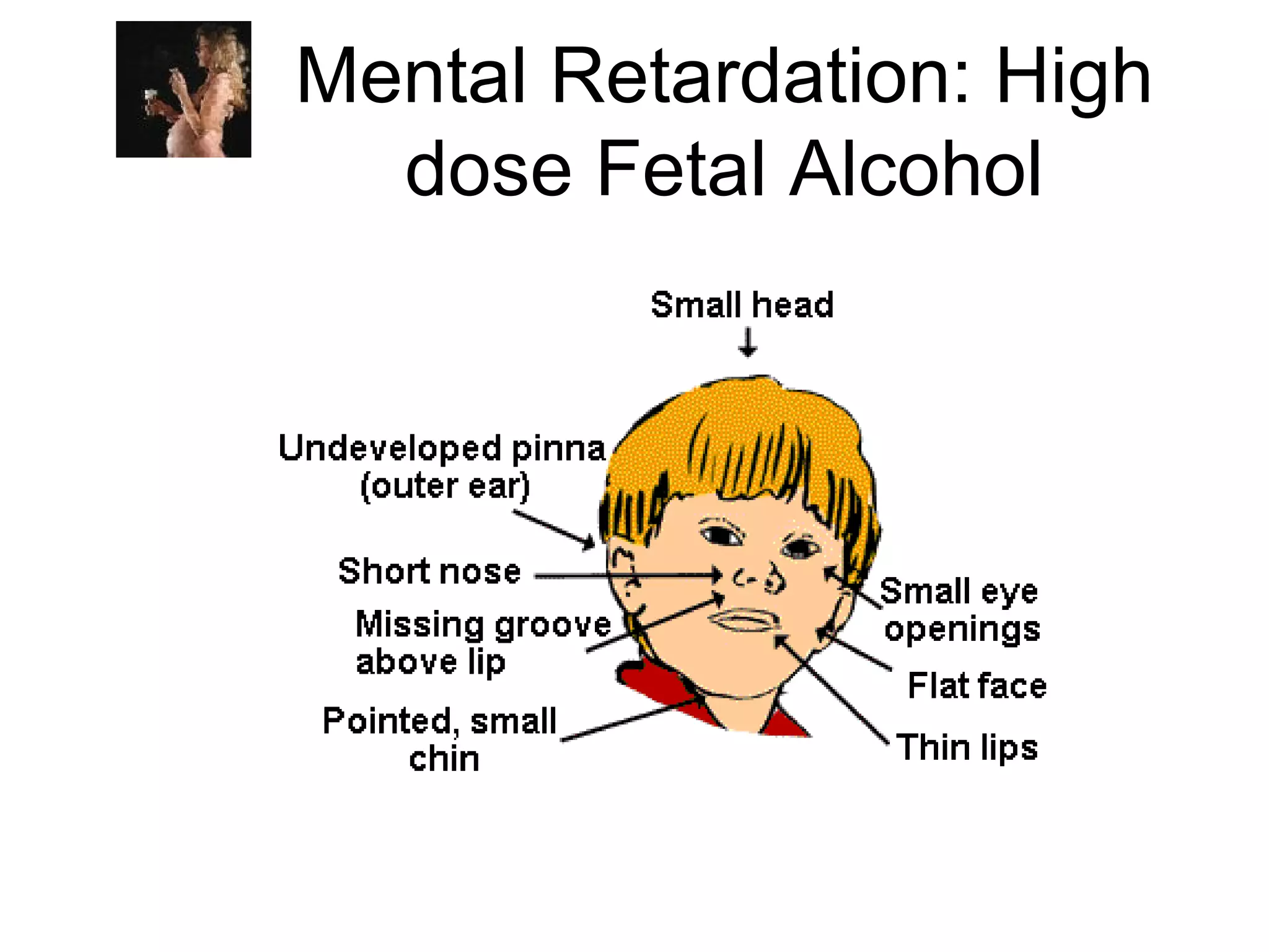 Mental Retardation: High
  dose Fetal Alcohol
 