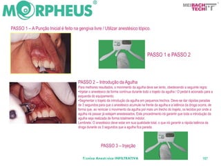 BACH
                                                                                                                           TECH



PASSO 1 – A Punção Inicial é feito na gengiva livre / Utilizar anestésico tópico.




                                                                                          PASSO 1 e PASSO 2



                                       PASSO 2 – Introdução da Agulha
                                       Para melhores resultados, o movimento da agulha deve ser lento, obedecendo a seguinte regra:
                                       •Injetar o anestésico de forma contínua durante todo o trajeto da agulha / O pedal é acionado para a
                                       esquerda do equipamento;
                                       •Segmentar o trajeto da introdução da agulha em pequenos trechos. Deve-se dar rápidas paradas
                                       de 3 segundos para que o anestésico acumule na frente da agulha e a latência da droga ocorra, de
                                       forma que, ao reiniciar o movimento da agulha por mais um trecho do trajeto, os tecidos por onde a
                                       agulha irá passar já estejam anestesiados. Este procedimento irá garantir que toda a introdução da
                                       agulha seja realizada de forma totalmente indolor.
                                       Lembrete: O anestésico deve estar em sua qualidade total, o que irá garantir a rápida latência da
                                       droga durante os 3 segundos que a agulha fica parada.




                                                       PASSO 3 – Injeção

                                          Técnica Anestésica INFILTRATIVA                                                          107
 